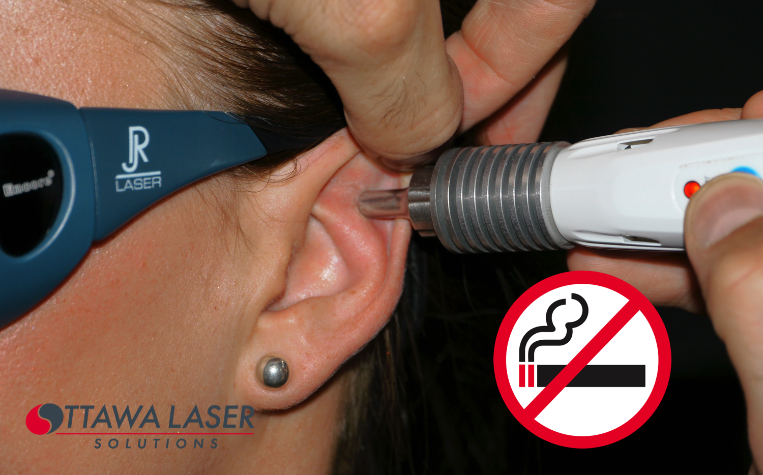 Quit Smoking Ottawa With Laser